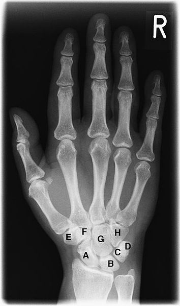 Radiograph of a right hand; the R marker identifies the patient’s right side.