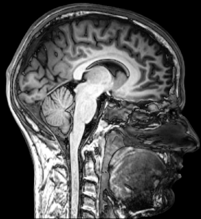 Approximately midline sagittal MRI of a human head.
