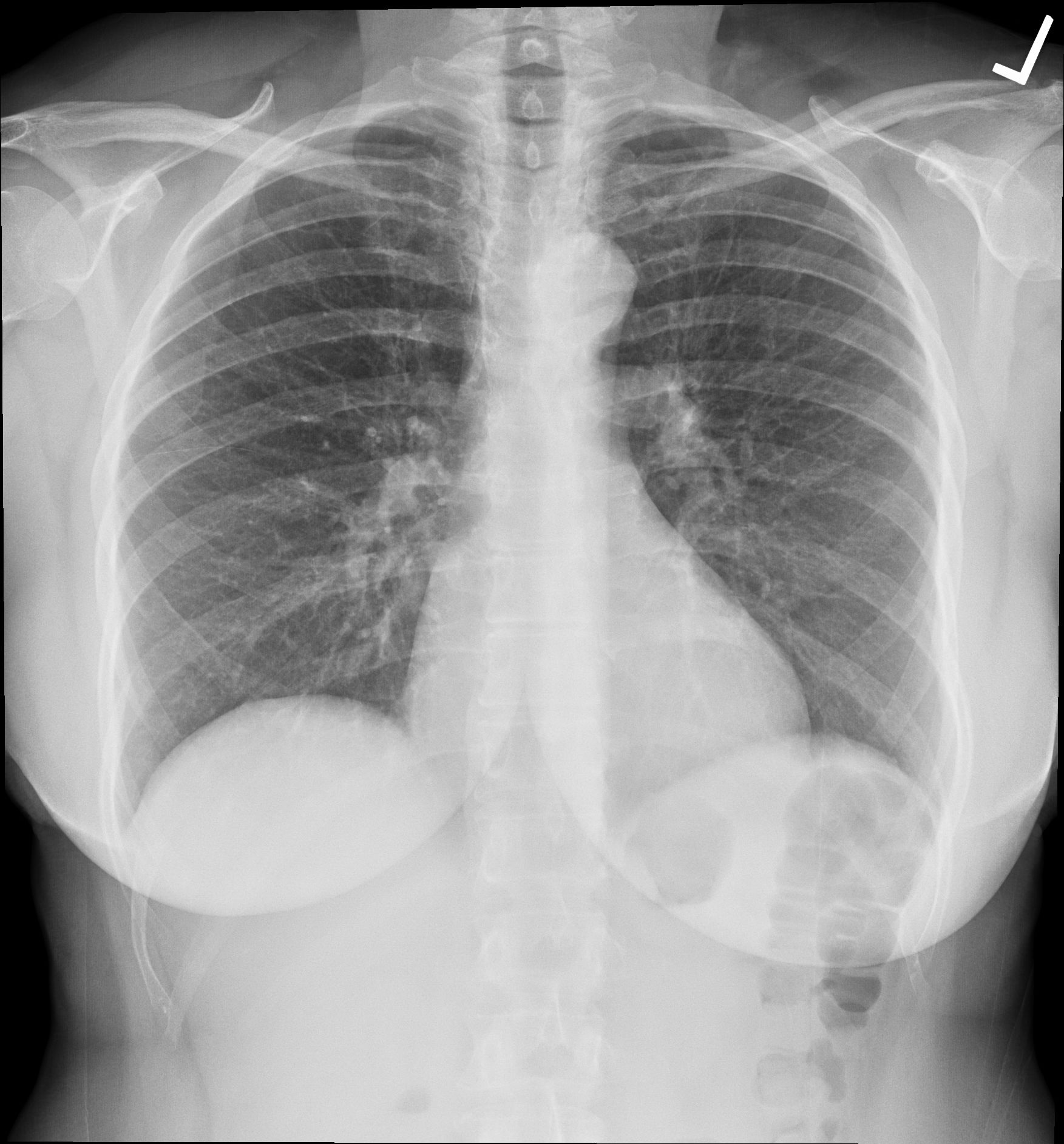 Chest radiograph with a visible left-side marker. The source describes the image as normal.