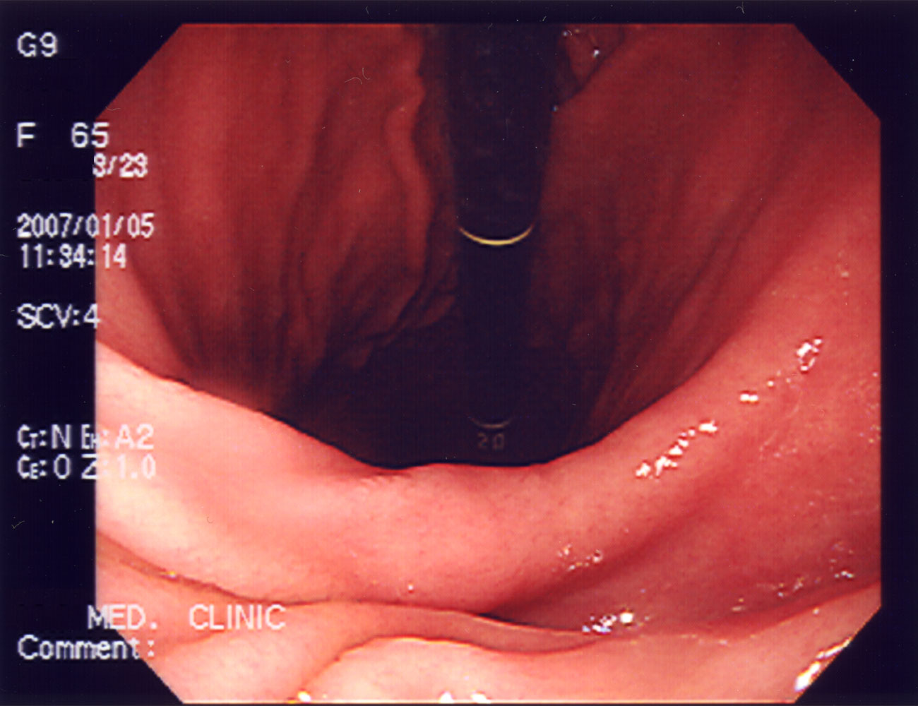 Endoscopic view of the stomach body, described as normal in the source record.