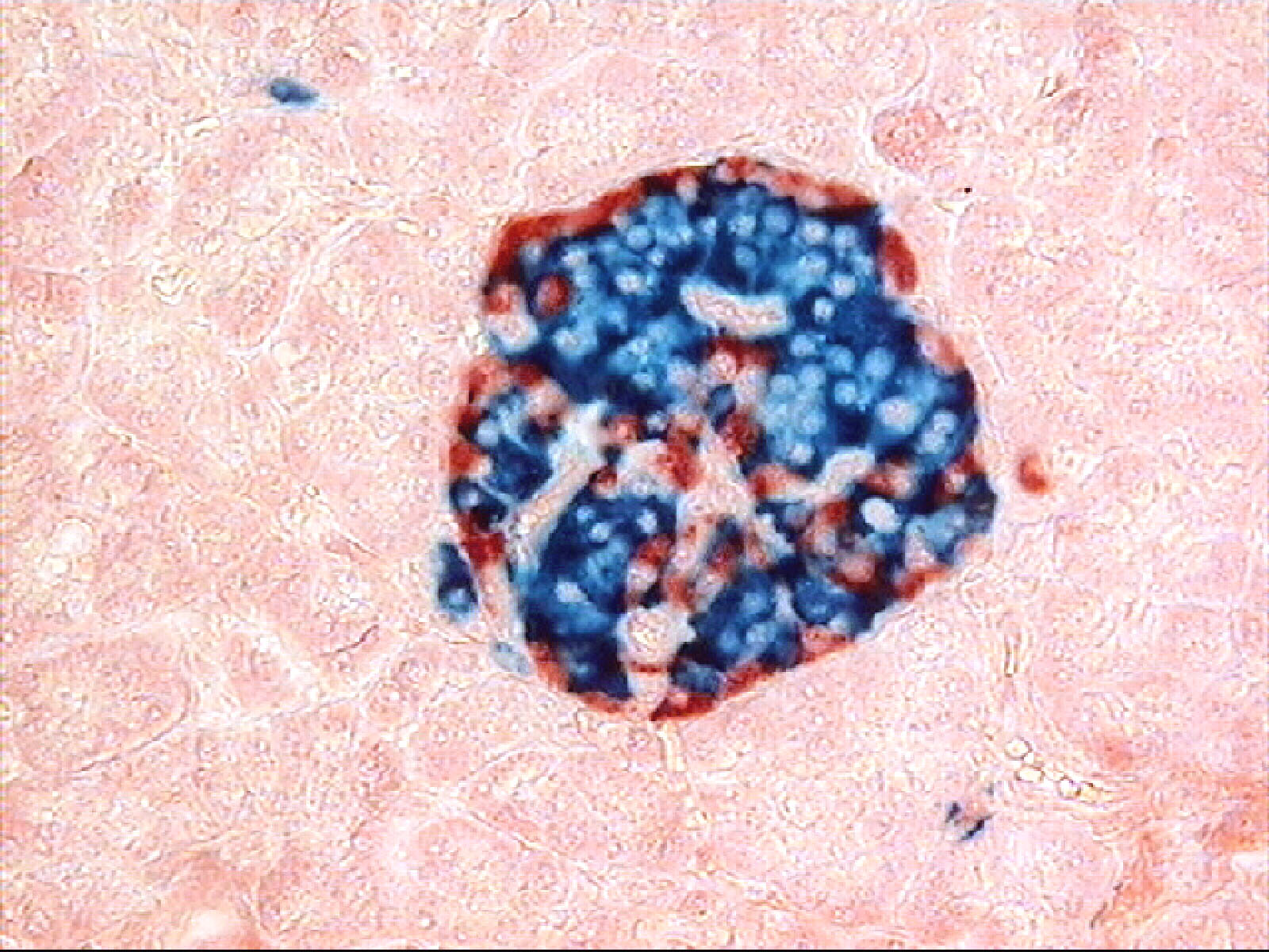 Real human pancreatic islet visualized by double immunostaining: red identifies glucagon immunoreactivity and blue identifies insulin immunoreactivity. These are staining colors, not natural tissue colors.
