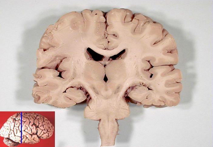Photograph of a human brain in a frontal (coronal) section, with an original orientation inset.